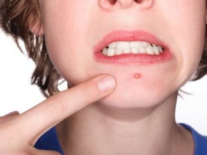 Avoid Any Further Outburst of Your Acne
